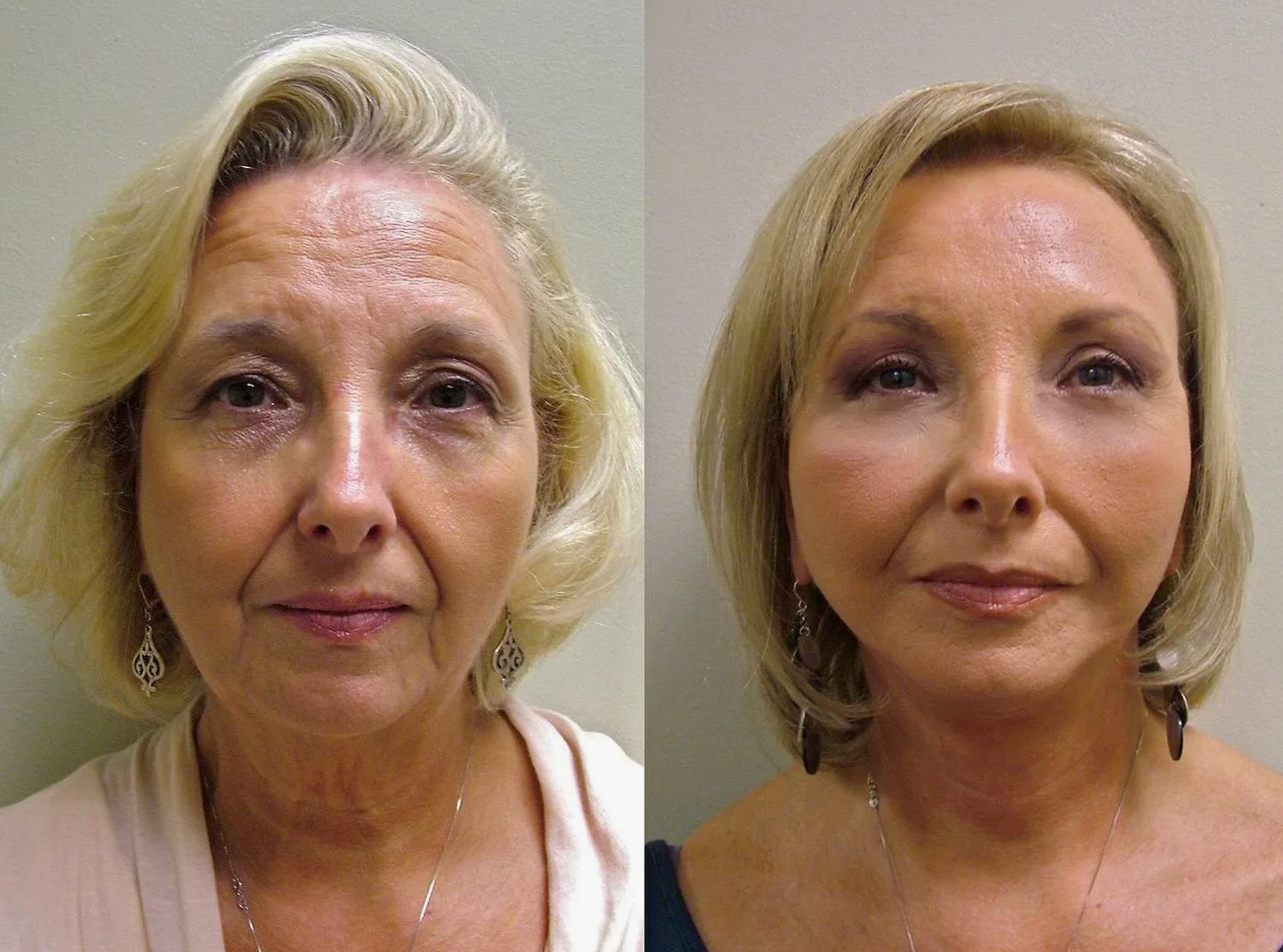 До и после 4